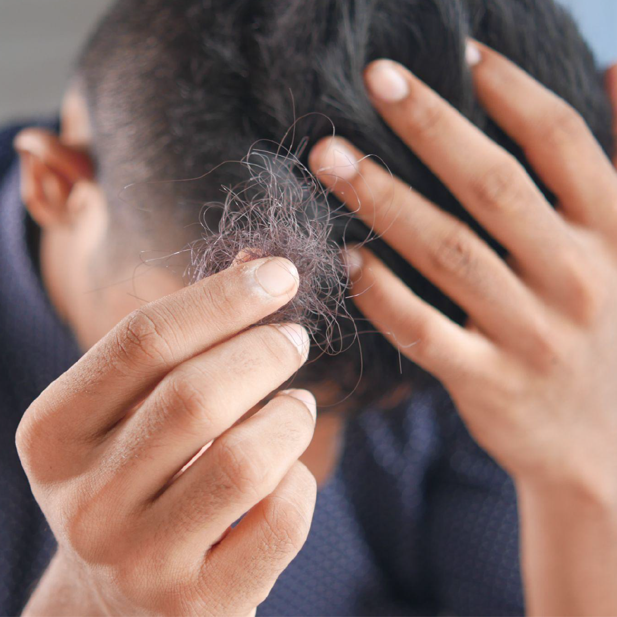 Can Stress Impact Hair Loss?